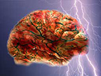 Childhood Epilepsies