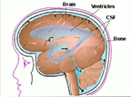 Normal Pressure Hydrocephalus