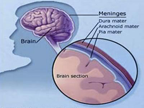 Meningitis